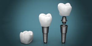 dental implants
